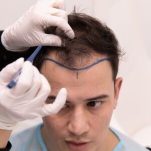 Designing a Natural Hairline: The Art of the Hair Transplant