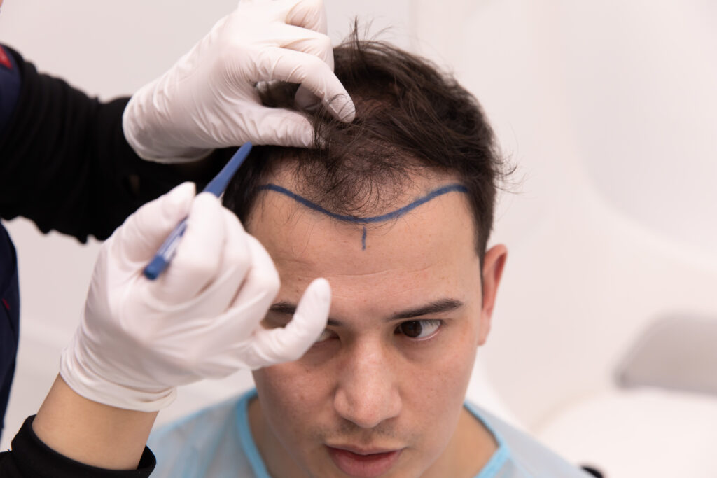Designing a Natural Hairline: The Art of the Hair Transplant